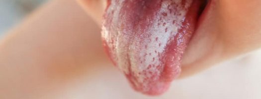 White Tongue on Baby? A Guide to Oral Thrush