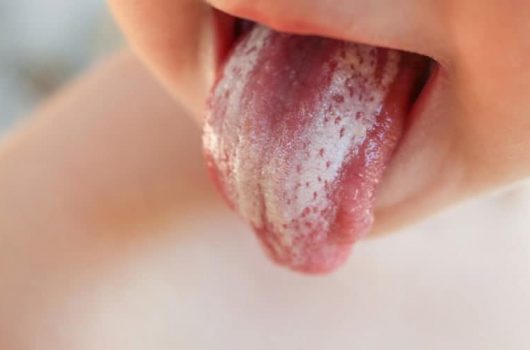 White Tongue on Baby? A Guide to Oral Thrush