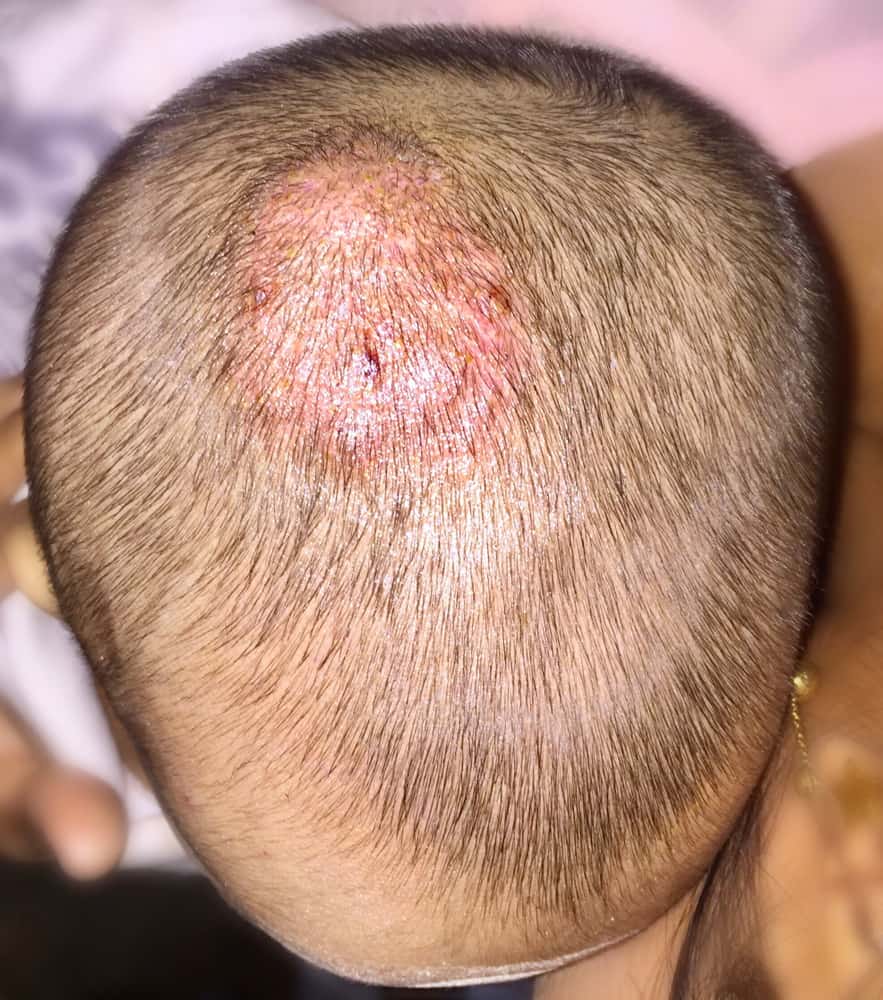 Child with hair loss due to scalp ringworm infection