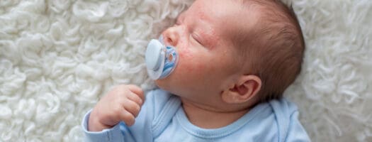 Neonatal Acne: How to Identify and Treat Your Baby’s Spots