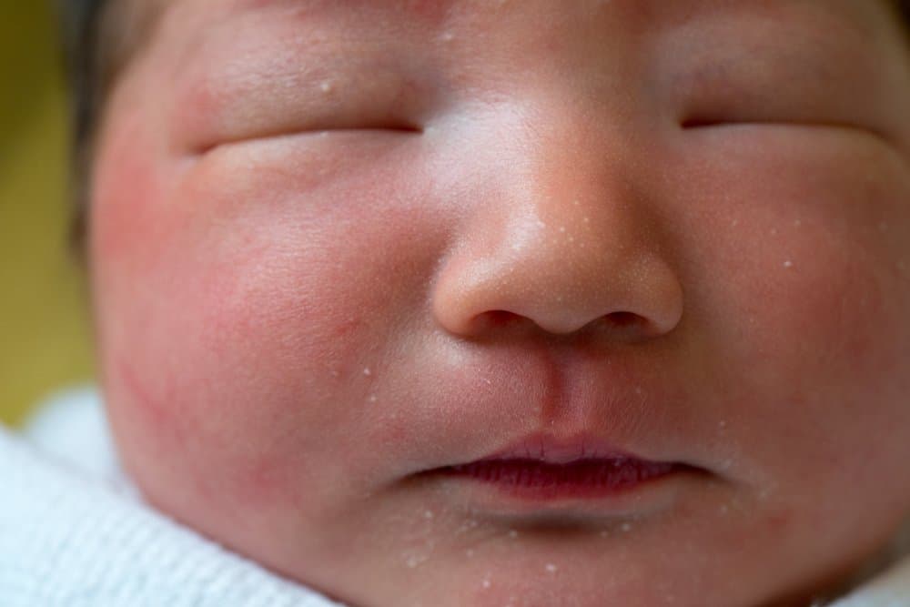 newborn baby with neonatal acne