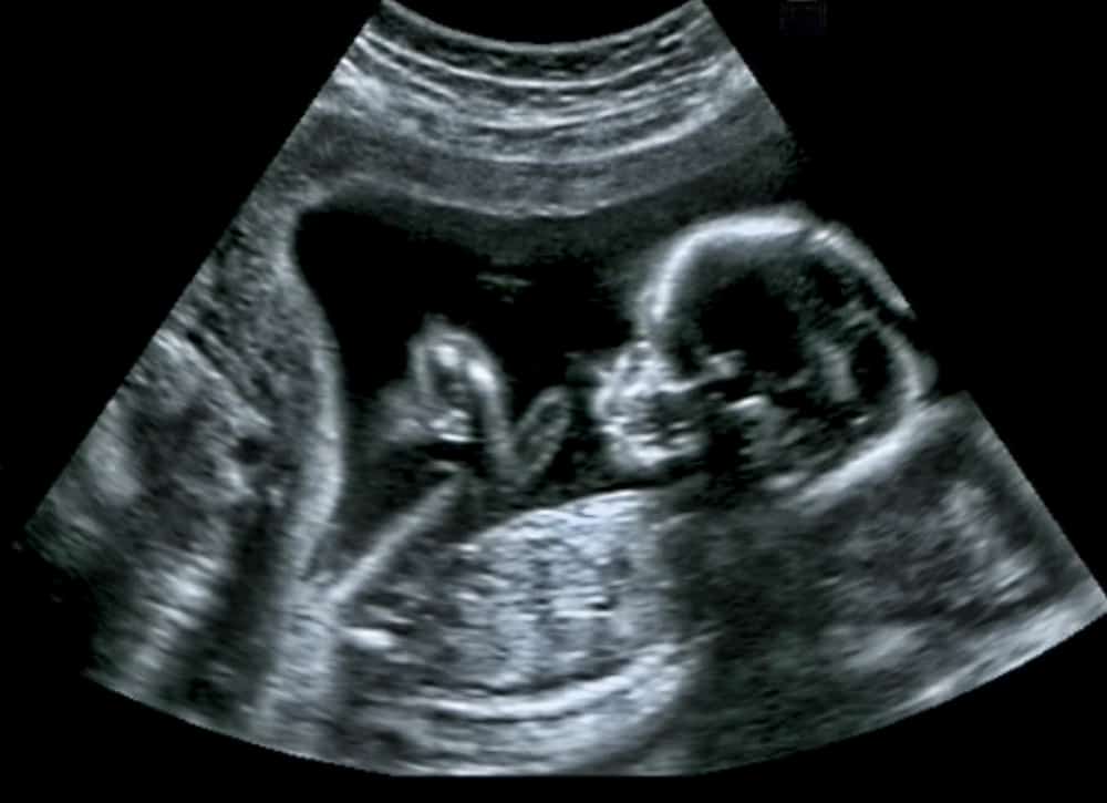an ultrasound scan image of a baby in the uterus
