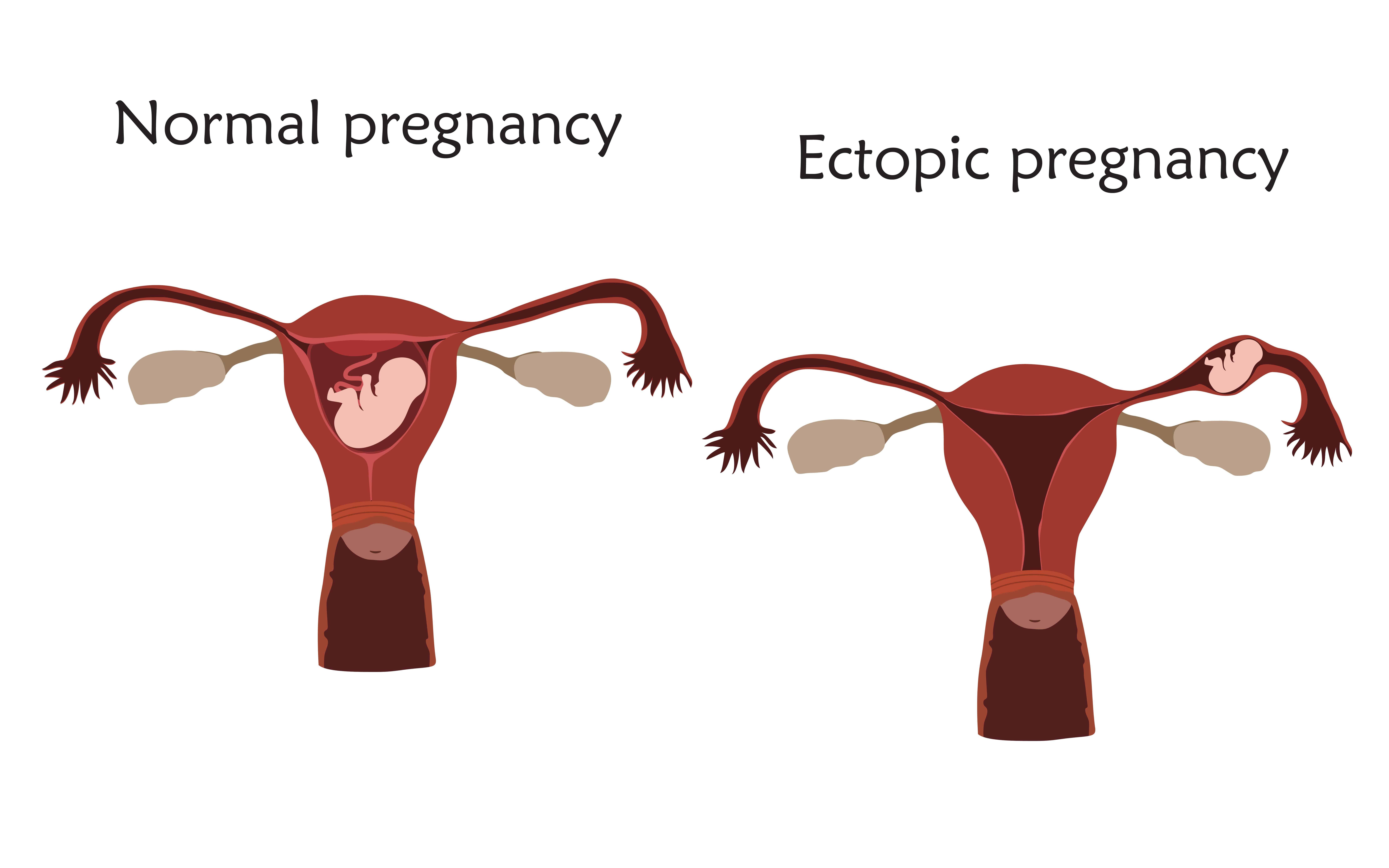 an infographic showing the location of a normal and an ectopic pregnancy