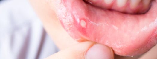 Why Am I Suffering From Mouth Ulcers During Pregnancy?