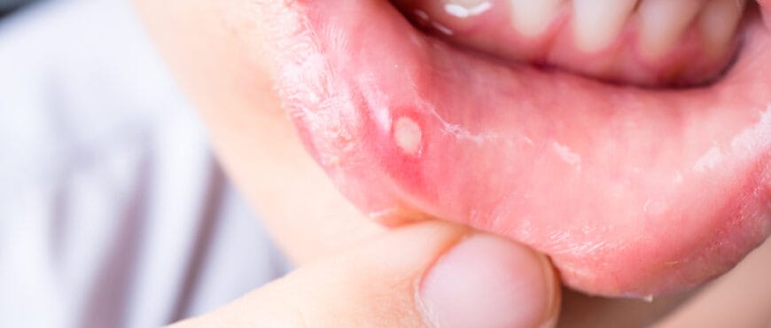 why-am-i-suffering-from-mouth-ulcers-during-pregnancy-littleonemag