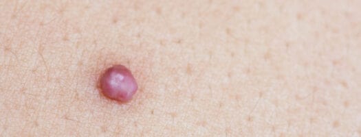 Should I Be Worried About Developing Skin Tags During Pregnancy?