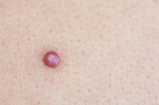 Should I Be Worried About Developing Skin Tags During Pregnancy?