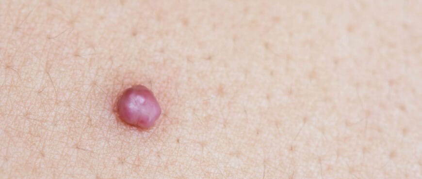 Should I Be Worried About Developing Skin Tags During Pregnancy