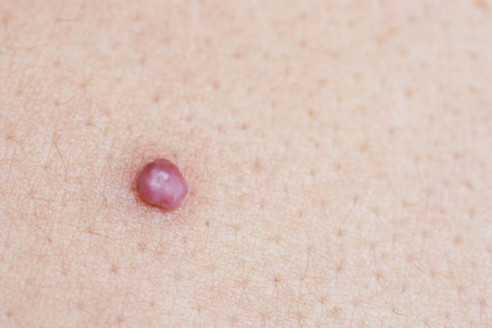 Should I Be Worried About Developing Skin Tags During Pregnancy